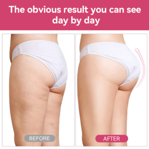 Read more about the article Top Benefits of Combining Body Contouring with Renuvion Skin Tightening