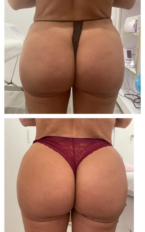 Radiesse-Non-Surgical-Butt-Lift3-q3hs6a1ofpz1e38i4ut91lx7g97olf5uw1yczx1j5s