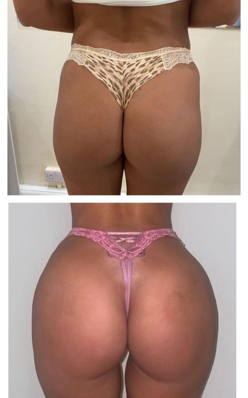 Radiesse-Non-Surgical-Butt-Lift4-q3hs5v09edeg8buckob7xppty39t69i5hzilbhntxc