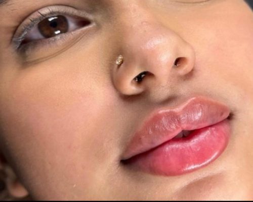 lip fillers before after