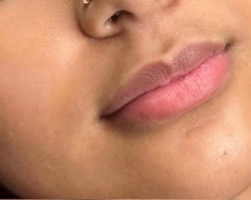 lip fillers before after